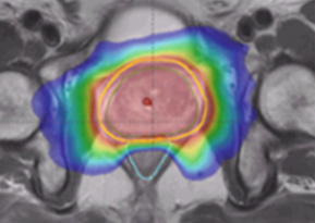 Example of newer-style treatment