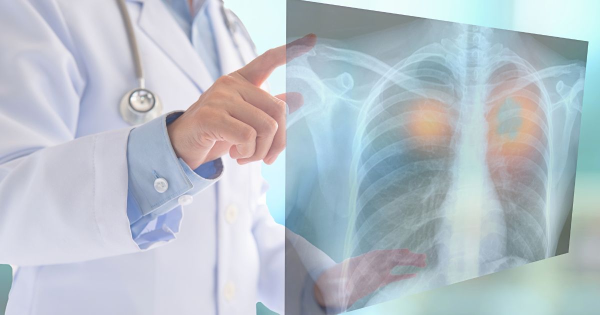 Lung Cancer