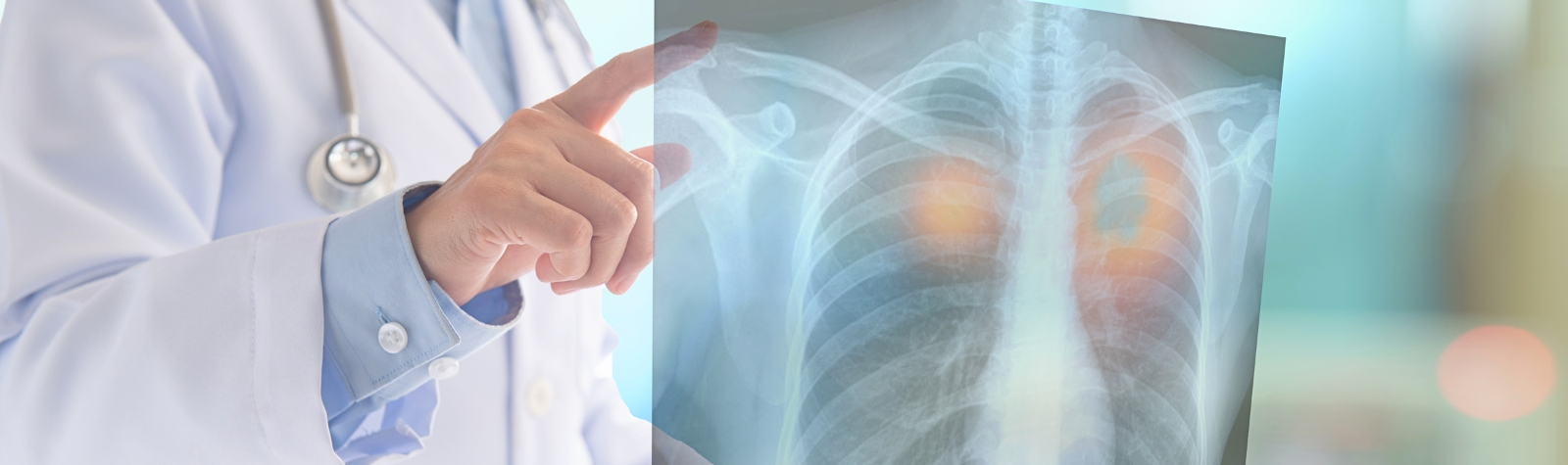 What Is Lung Cancer? Symptoms, Risk Factors, Types, and Treatment